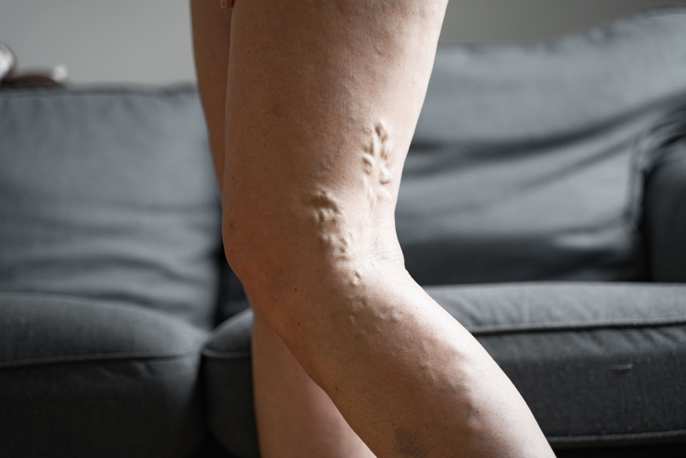 What Are Varicose Veins and Why Treatment Matters